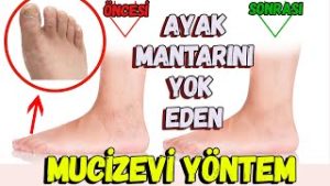 Ayak mantarına çözüm bulundu