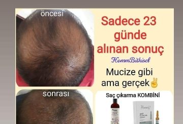 Saç Çıkartan Mucize Bitkisel Ürün